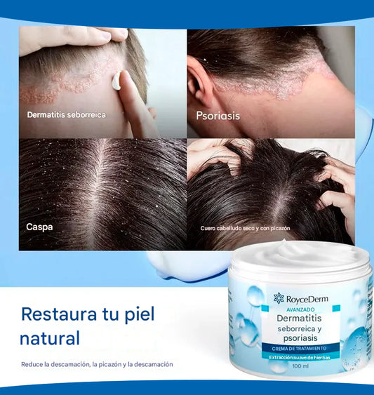 ROYCE DERM ™ - ELIMINA LA CASPA, DERMATITIS Y PSORIASIS 100% EFECTIVA ✅